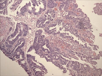 Biopsie Darmtumor